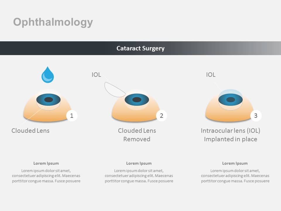 Ophthalmology Cataract PowerPoint Template